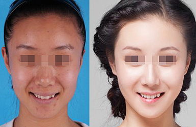 熱拉提的治療效果好不好？多久起效？